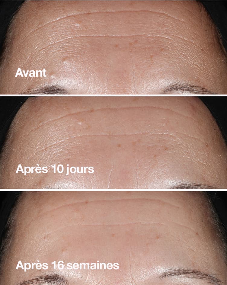 Avant. Après 10 jours. Après 16 jours.
